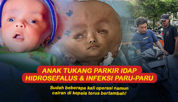 Terkendala Biaya, Bantu Anak Hidrosefalus Ini Berobat