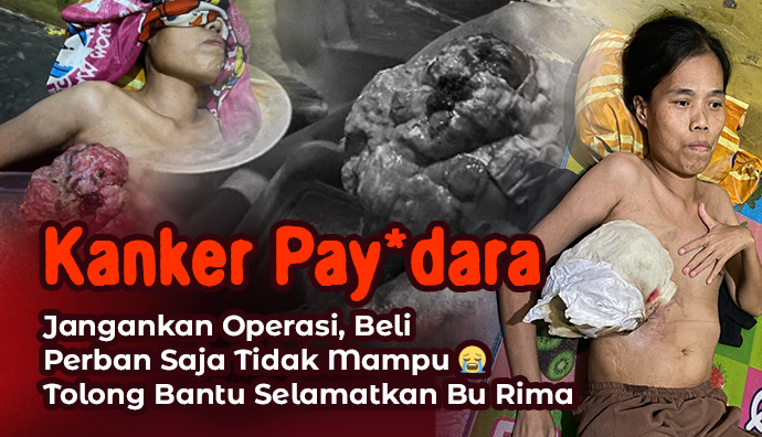 Tak Bisa Operasi ! Bantu Bu Rima Berjuang Lawan Kanker