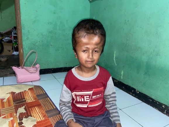 Bantu Yatim (11) Idap Hidrosefalus Bisa Operasi