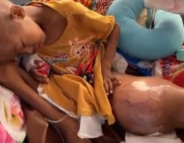 Tumor Tumbuh di Kaki, Cita Butuh Operasi Kedua