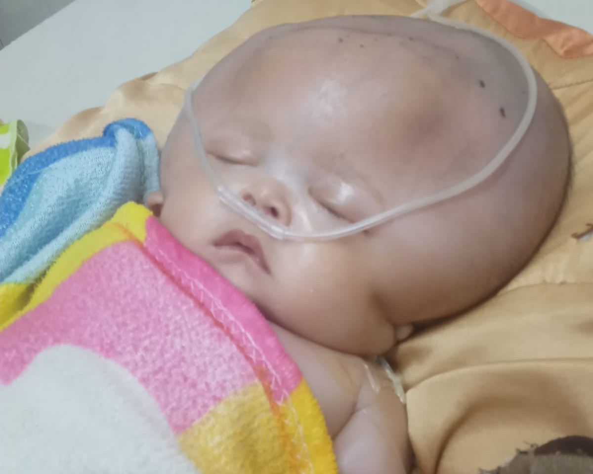 Idap Hidrosefalus, Bayi Khalid Butuh Operasi