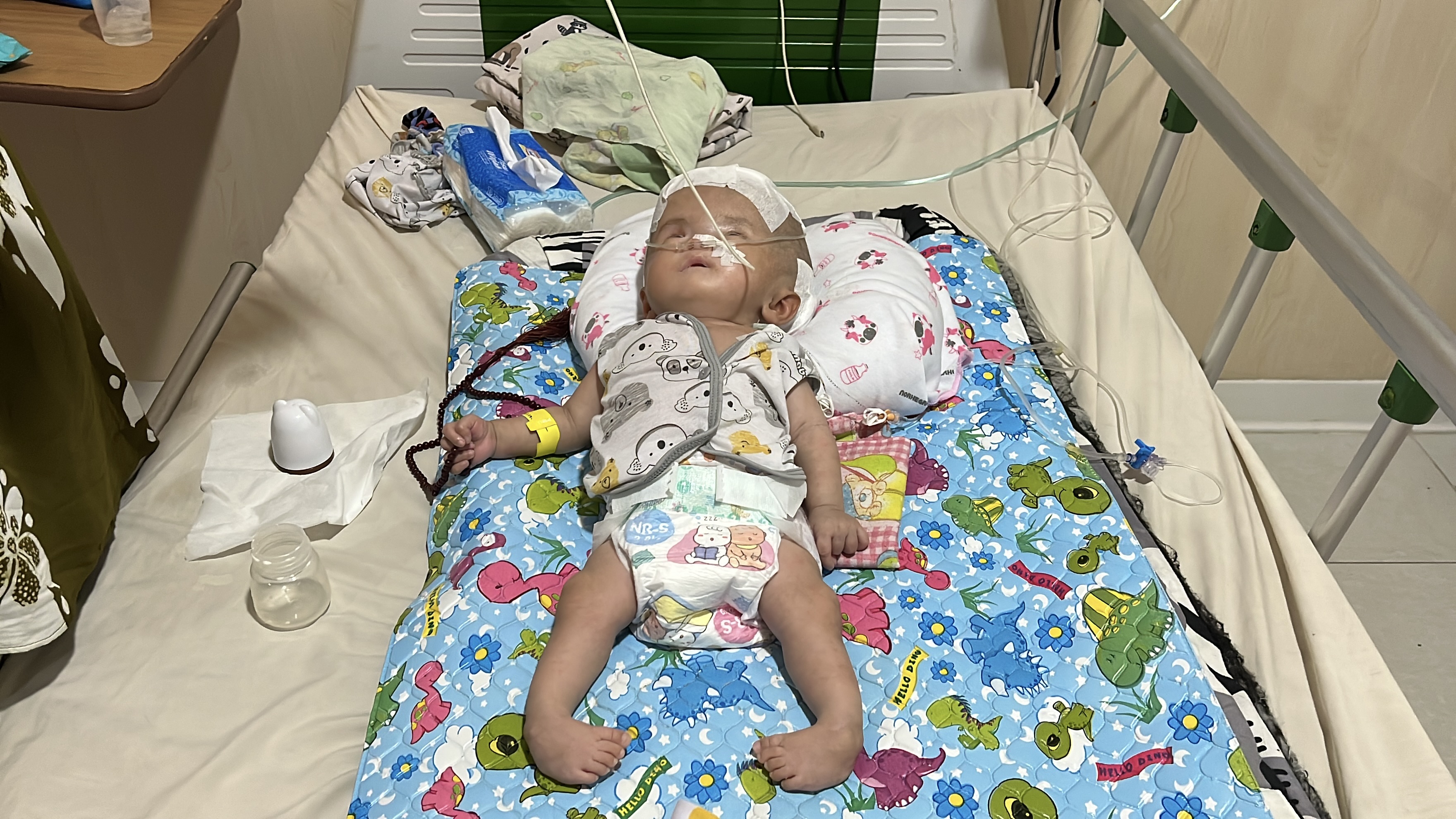 Sering Kejang, Bayi Hidrosefalus Ini Butuh Operasi Segera