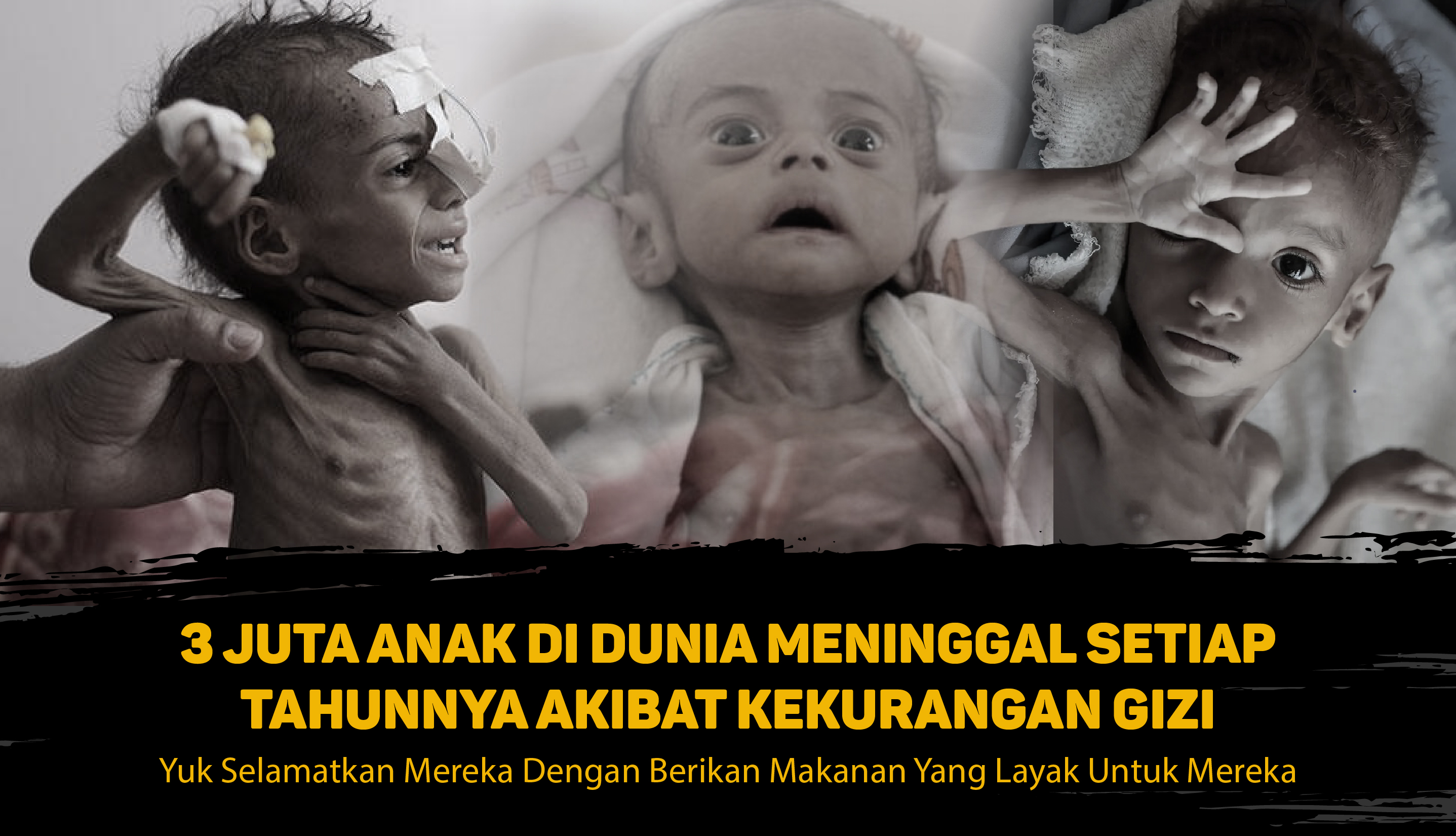 Darurat!! Permasalahan Gizi Buruk Pada Anak Semakin Meningkat